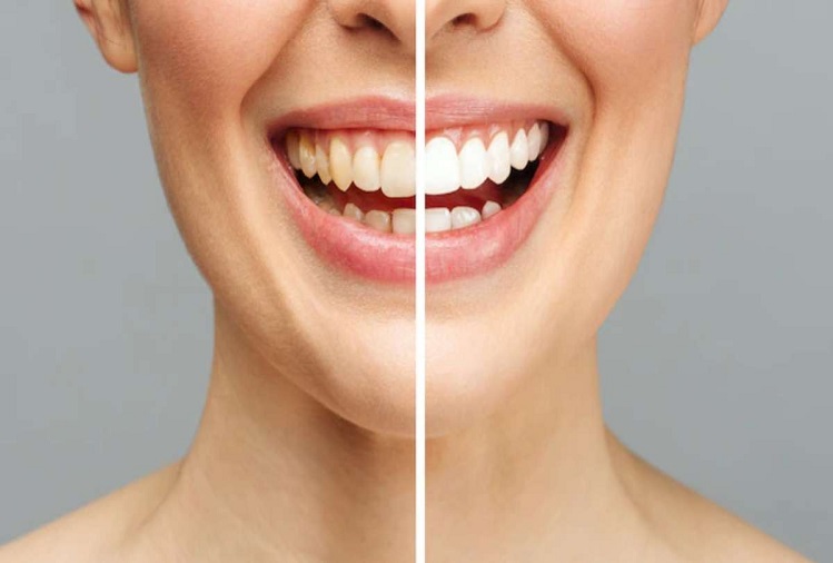 Beauty Tips: Yellowing of teeth is spoiling your beauty, so you can clean it like this