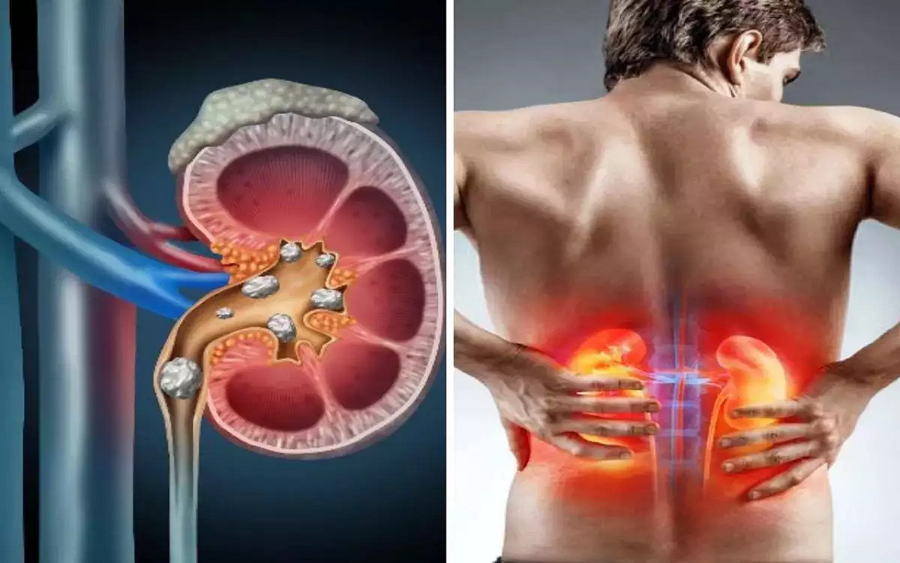 Health Tips: These foods can prevent kidney stones, include them in your diet today.