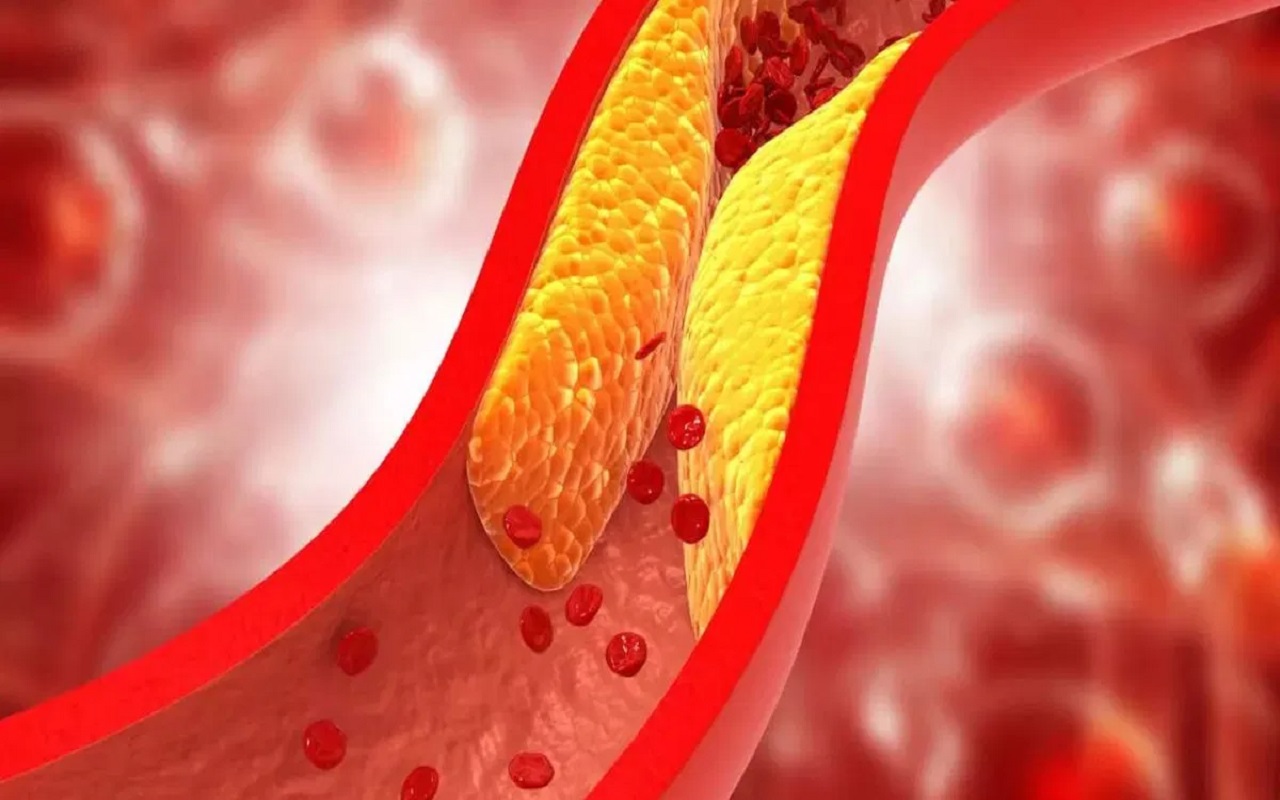 Health Tips: To reduce increased cholesterol, follow these tips