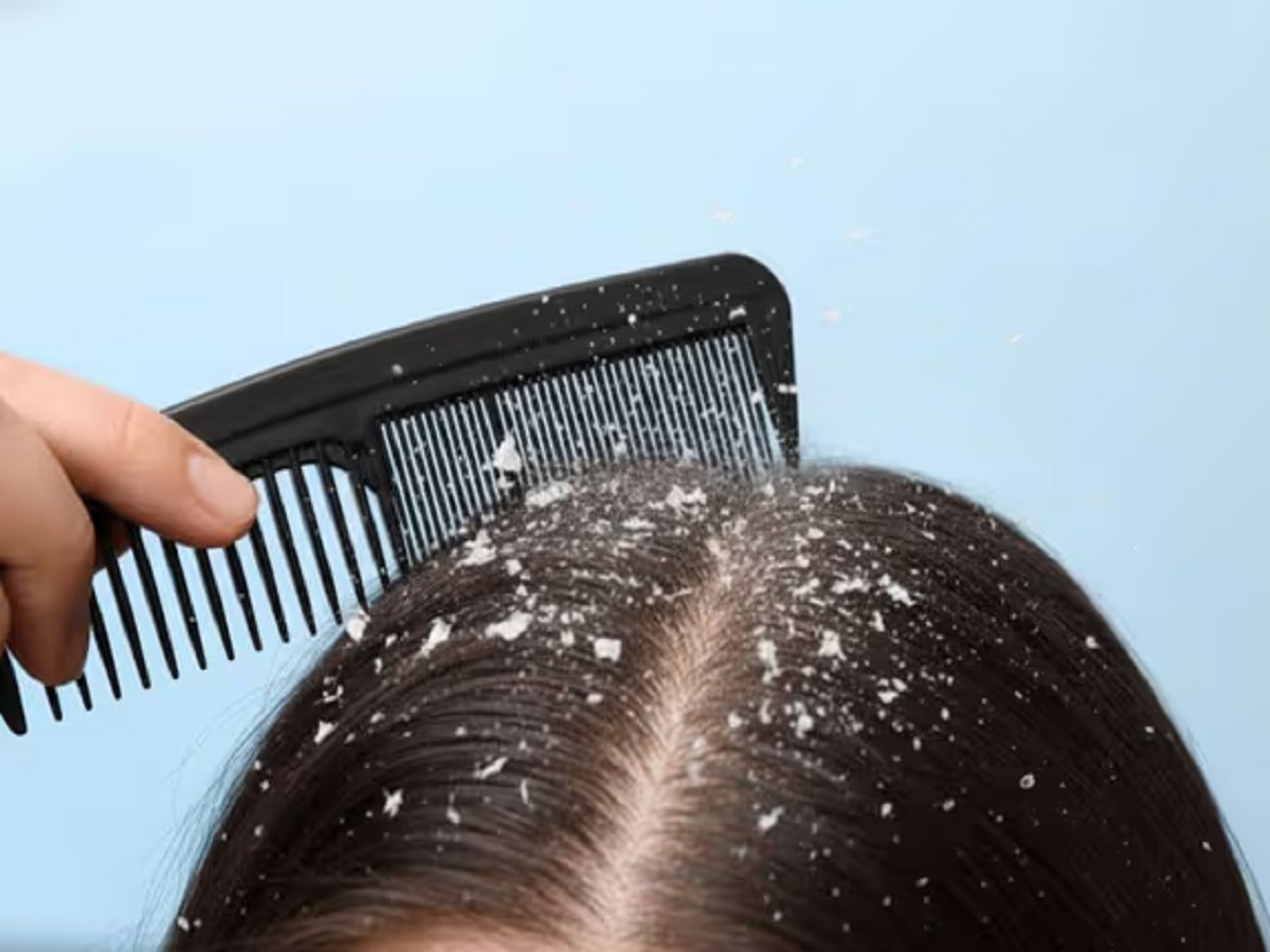 Hair Care Tips: Yogurt can get rid of dandruff; here's how to use it.