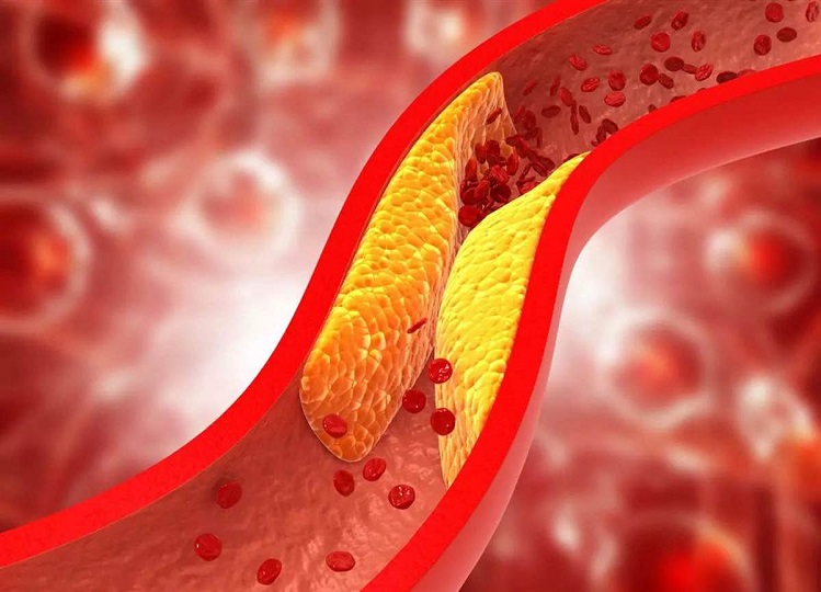 Health Tips: If your cholesterol has increased, you can also reduce it, but you will have to do this work.
