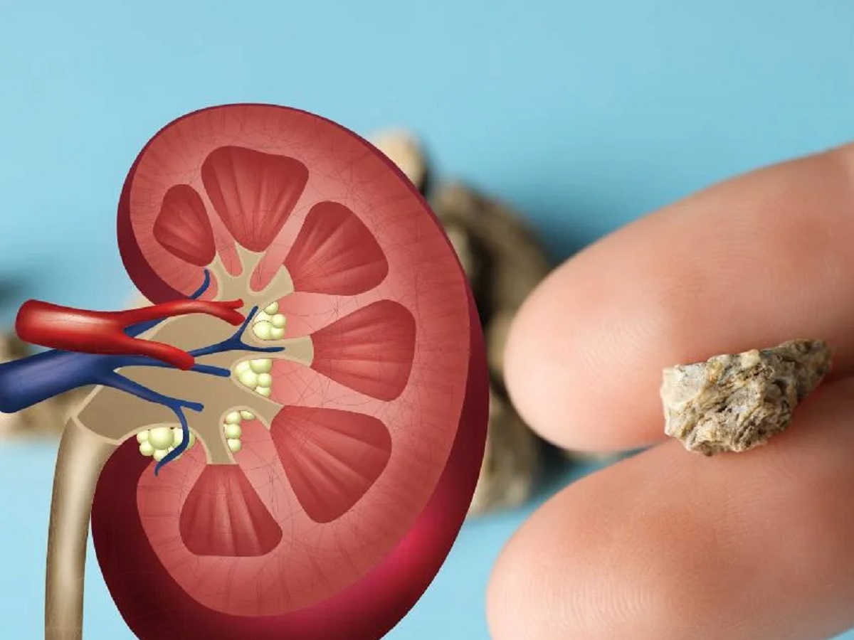 Health Tips: This mistake causes stones in the body, definitely do this in the summer season
