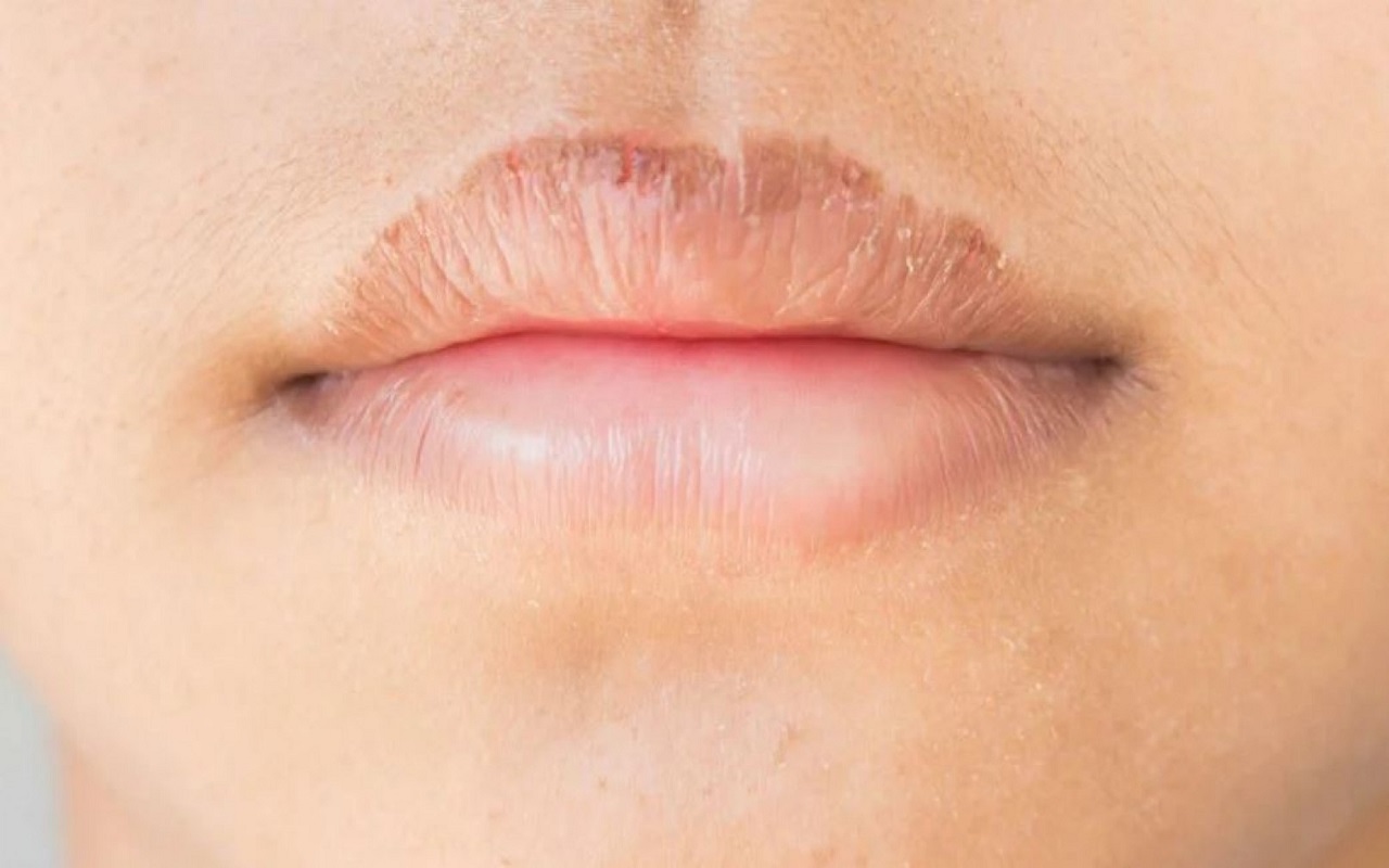 Beauty Tips: If your lips are chapped in summer then follow these tips