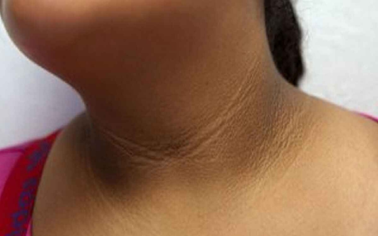 Beauty Tips: You can also remove dark neck spots with these tips, your beauty will increase.