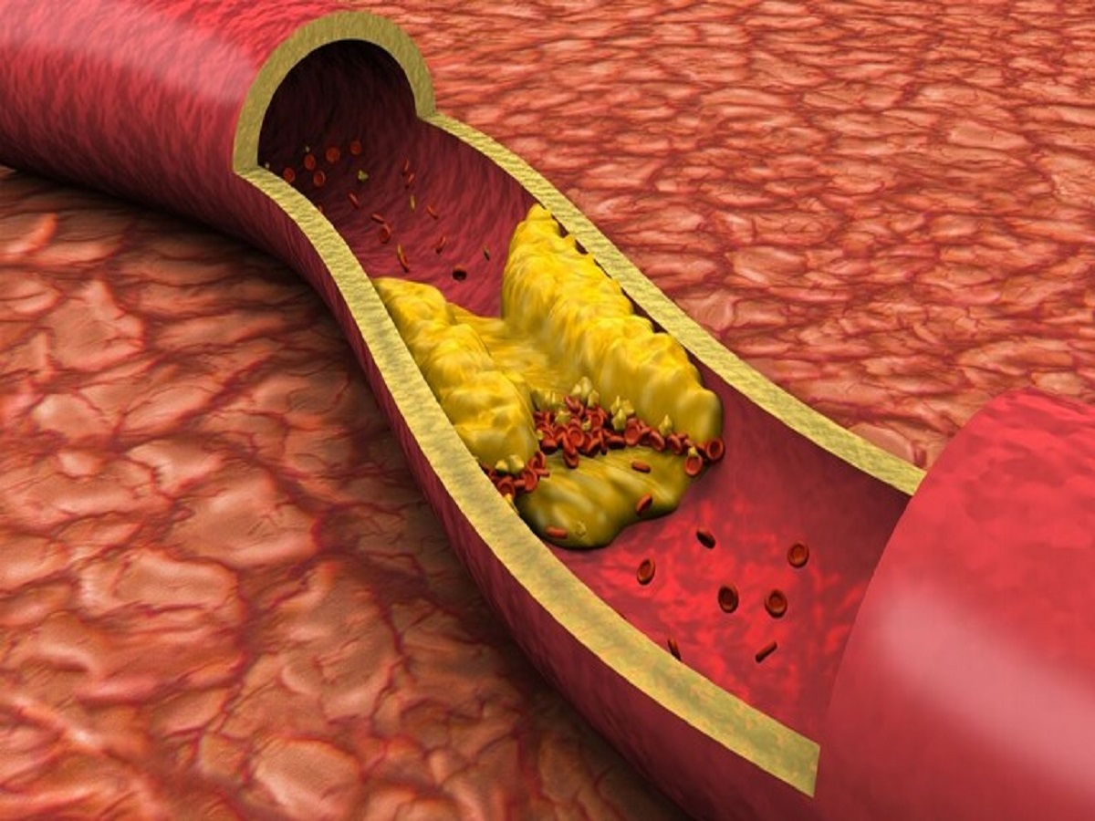 Health Tips: If you start noticing these signs, understand that your cholesterol levels are rising.