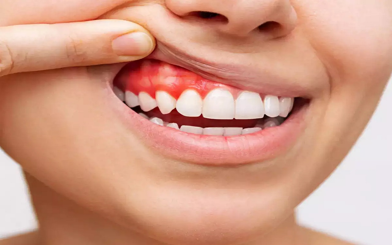 Health Tips: If your gums bleed frequently, you can also adopt these tips.