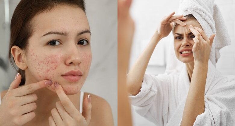 Acne In Winters: Troubled by pimples in the winter season? These are the ways to deal with pimples in winter