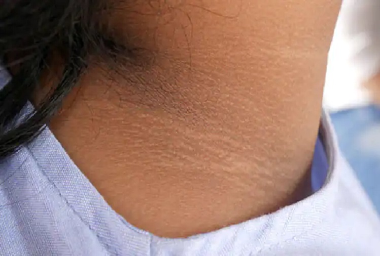 Health Tips: If you are troubled due to dark neck then these tips will make a difference