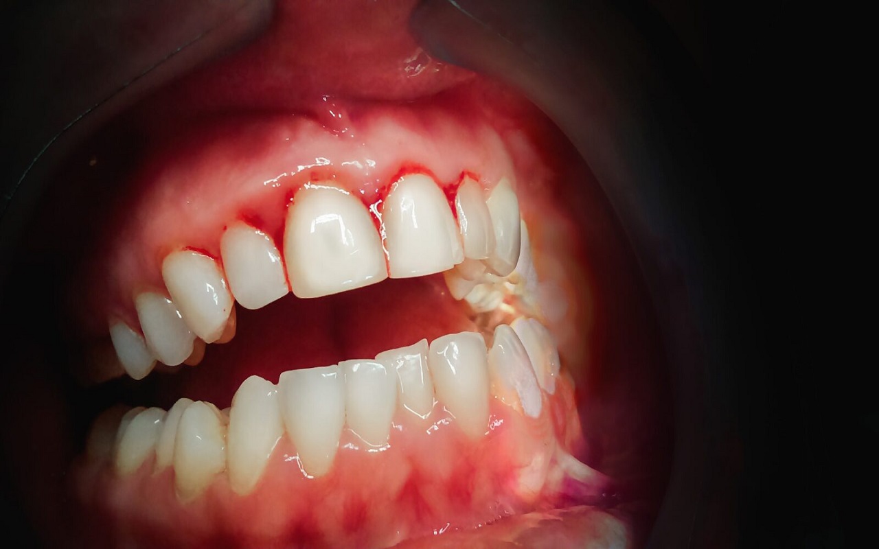 Health Tips: If blood is coming from your teeth or gums, it can be dangerous, do this immediately