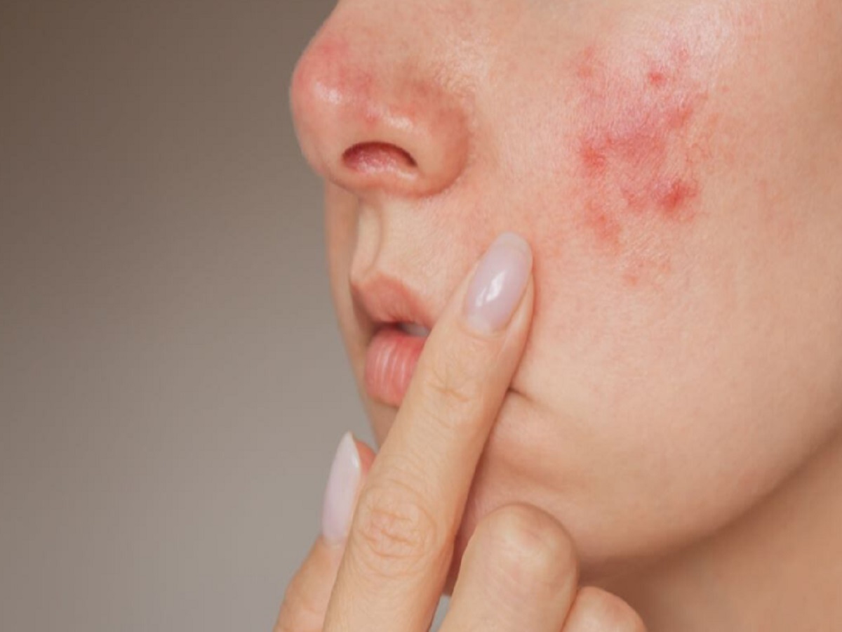 Skin care Tips: Suffering from Recurrent Acne? Here Are the Possible Causes You Should Know About.