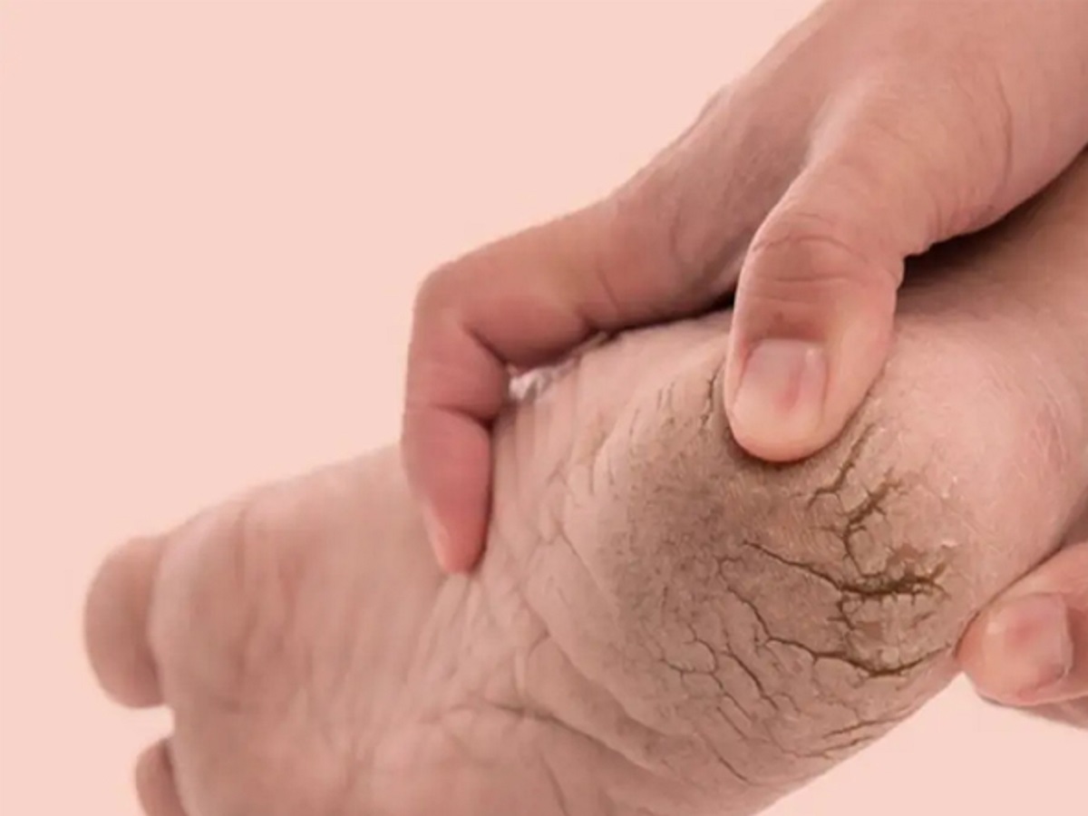 Skin Care Tips: Try these home remedies to soften cracked heels