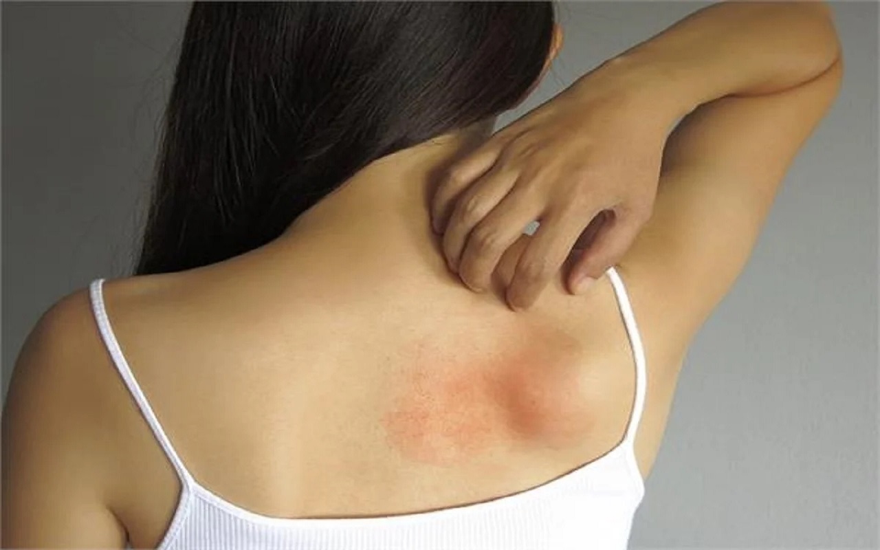 Beauty Tips: If you also have skin allergy from strong sunlight, then keep these things in mind