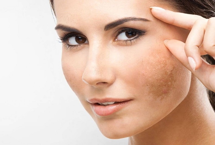 Beauty Tips: Use these things to remove freckles
