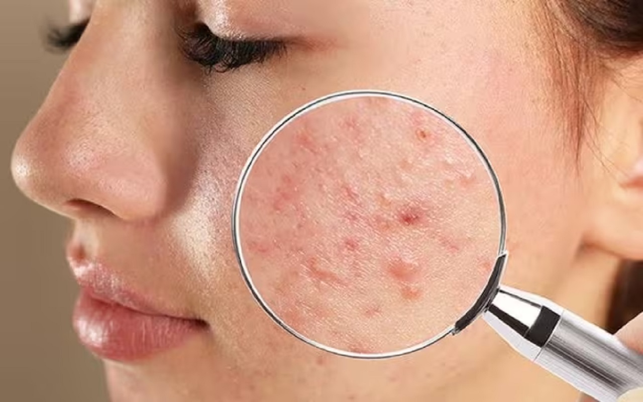Beauty Tips: Blind pimples are spoiling your beauty, then follow these tips
