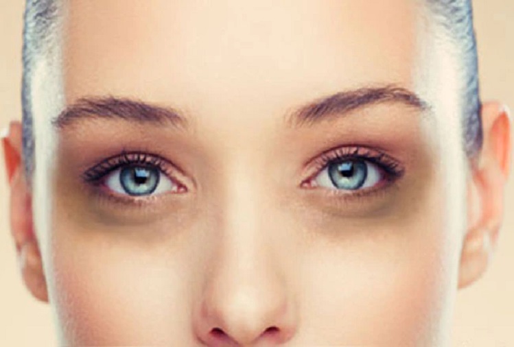 Beauty Tips: If you are troubled by the problem of dark circles, then follow this method, you will get benefit