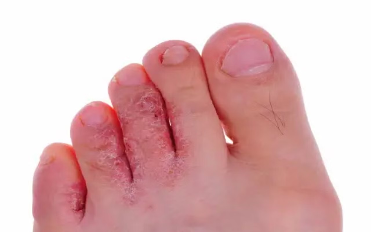 Health Tips: Fungal infection has occurred in the feet due to rain, then you can also adopt this method