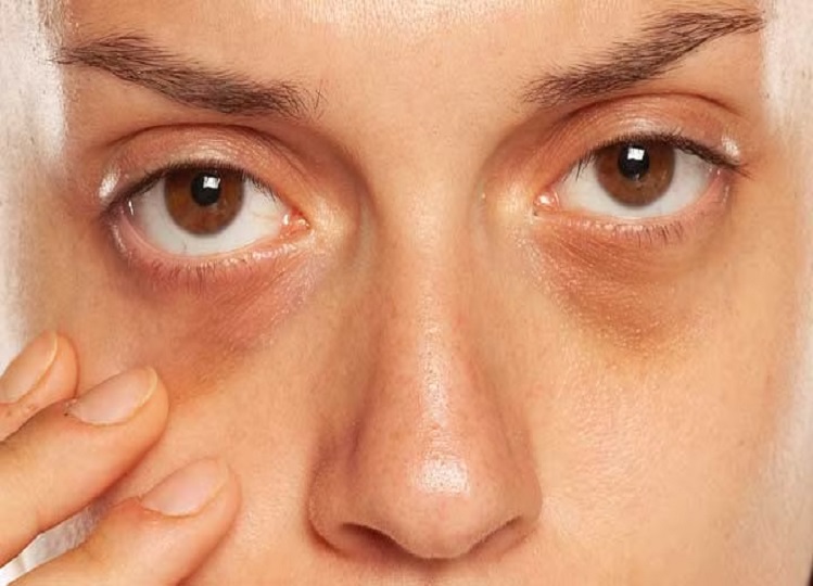 Beauty Tips: If dark circles are reducing your beauty, you can adopt these measures