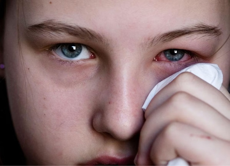 Health Tips: You can also adopt these measures to avoid eye flu