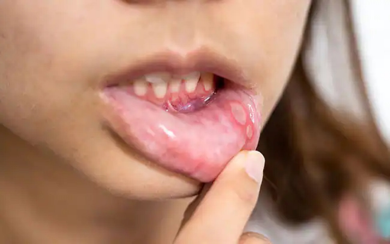 Health Tips: If you are troubled by mouth ulcers, then you should also do this remedy