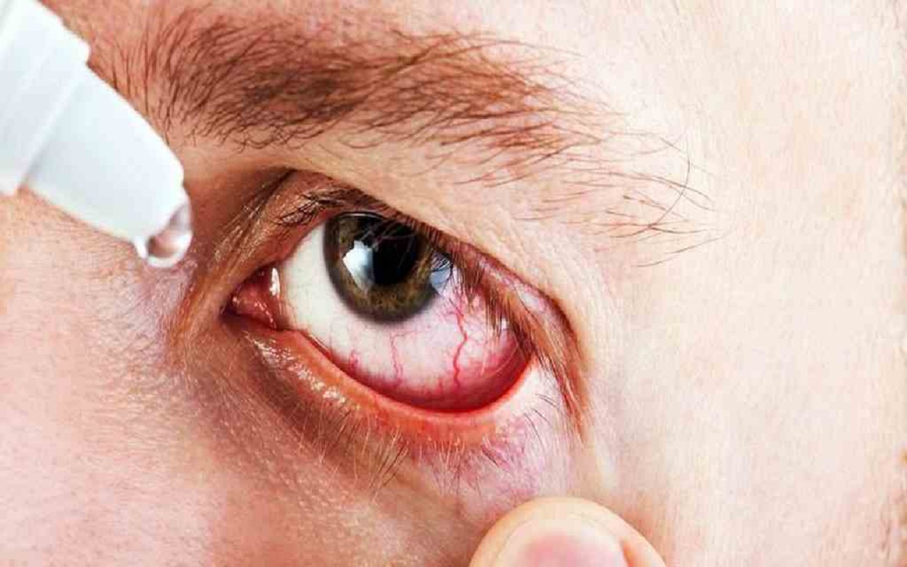 Health Tips: Burning sensation due to eye flu, you can also adopt these home remedies
