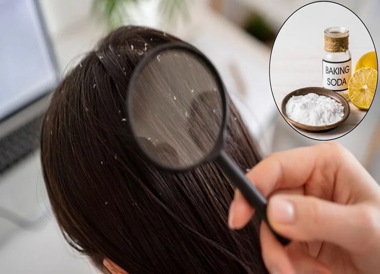 Hair Care: If you too are suffering from dandruff, then use baking soda like this