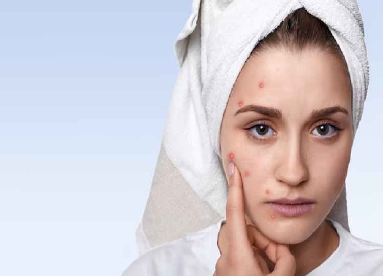 Skin Care Tips: The problem of pimples and acne on the face will go away, use curry leaves in this way