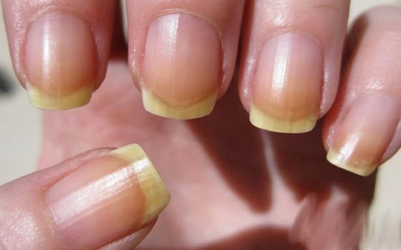 Health Tips: If you are also seeing yellow nails and along with these symptoms, then you must consult a doctor.