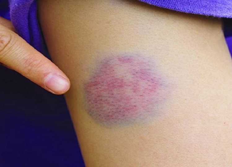 Health Tips: You can also remove the bruises visible on the body after injury in this way.